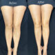 how-to-help-lipedema