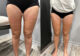 shock-waves-lipedema-experience